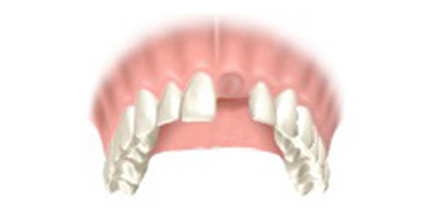 image-implant-une-dent