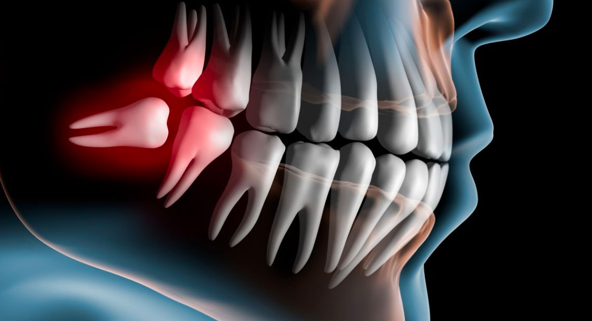 Extraction des dents de sagesse iSi Clinic
