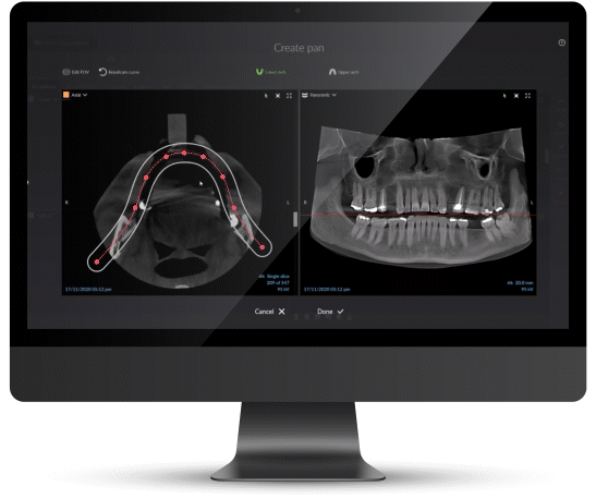 Prise d'empreintes dentaires 3D