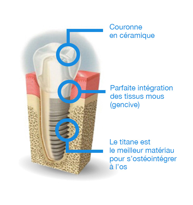 image-implant-une-dent