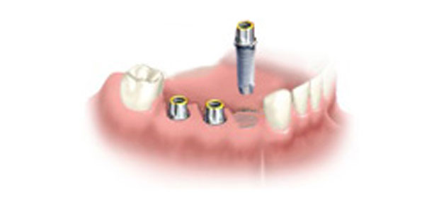 image-implant-une-dent