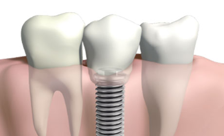 image-implant-une-dent