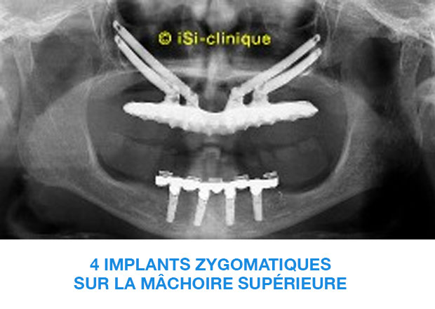 image-implant-une-dent