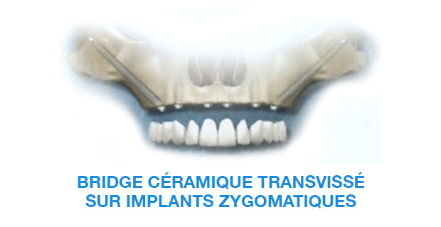 image-implant-une-dent